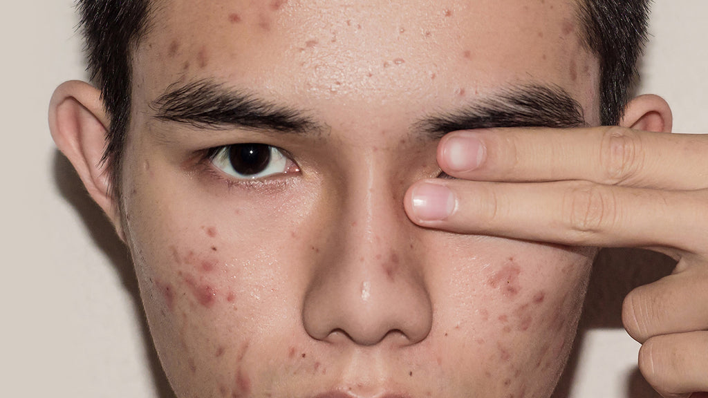 HOW TO REDUCE YOUR ACNE AS A MALE TEEN