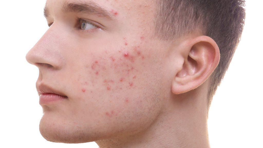 HOW TO TELL IF IT'S ACNE OR IF YOUR SKIN IS PURGING?